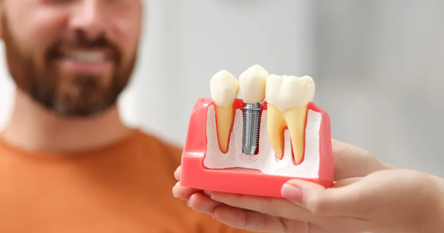 Revolutionize Your Smile: Full Mouth Dental Implants at Just $57/Month