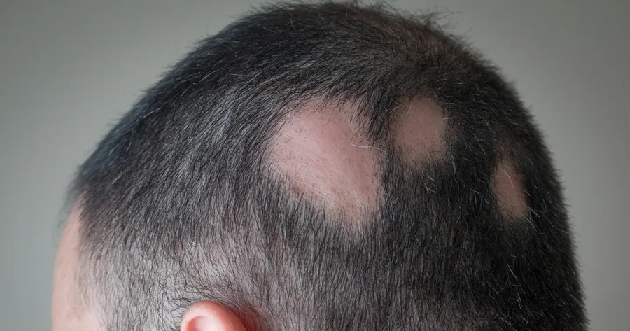 How Litfulo Transforms Alopecia Areata Treatment