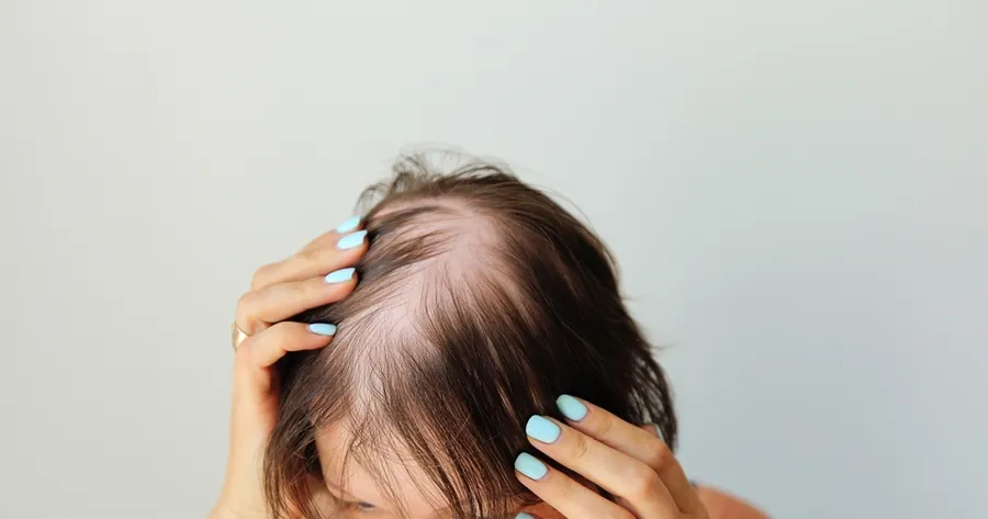 Transformative Treatments for Alopecia Areata
