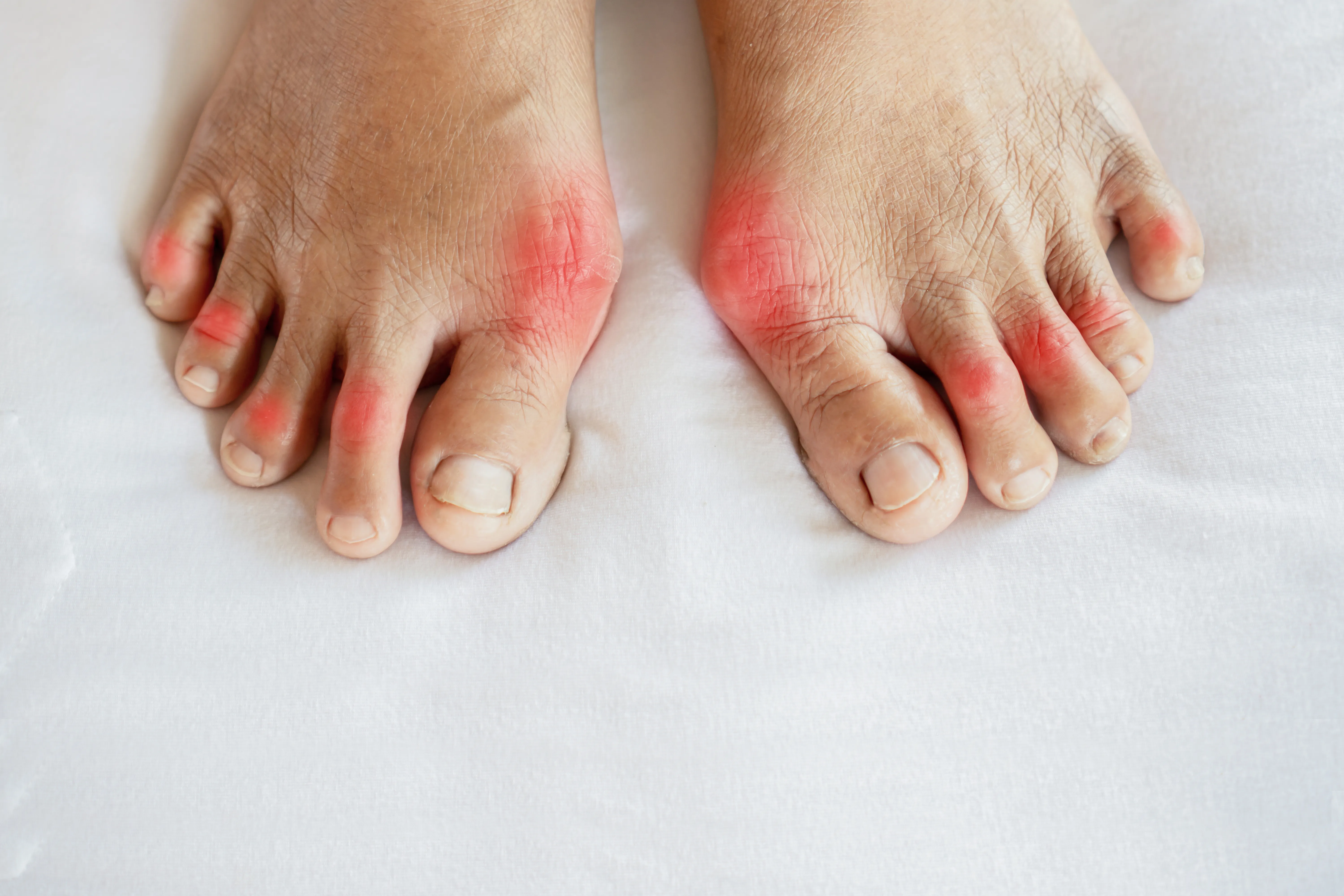 Identifying The First Signs of Psoriatic Arthritis (And Popular