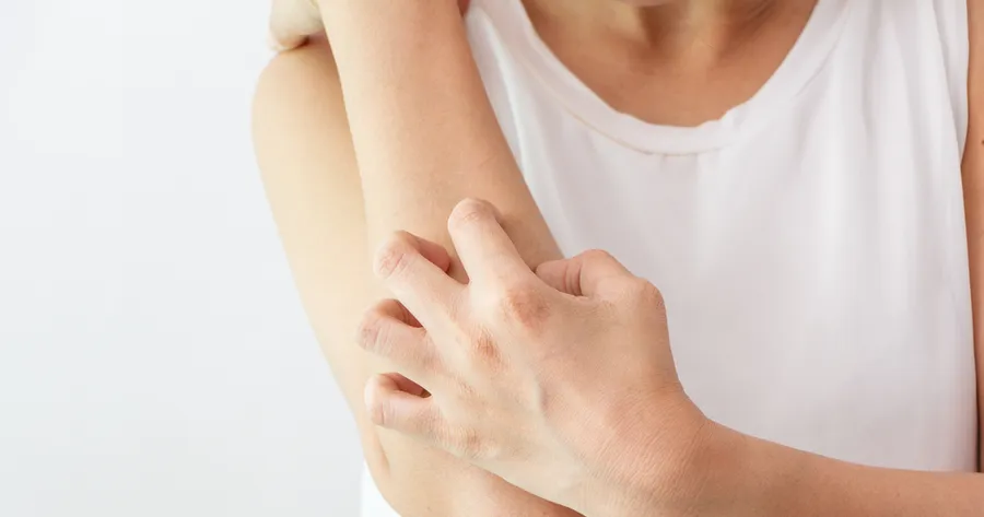 The Symptoms, Causes, and Treatment Of Atopic Dermatitis