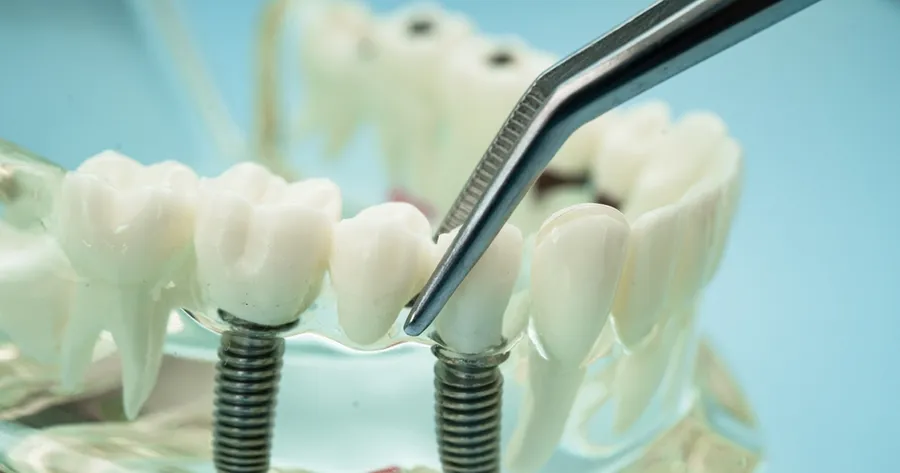 Navigating the Cost of Dental Implants: Tips for Affordable Solutions