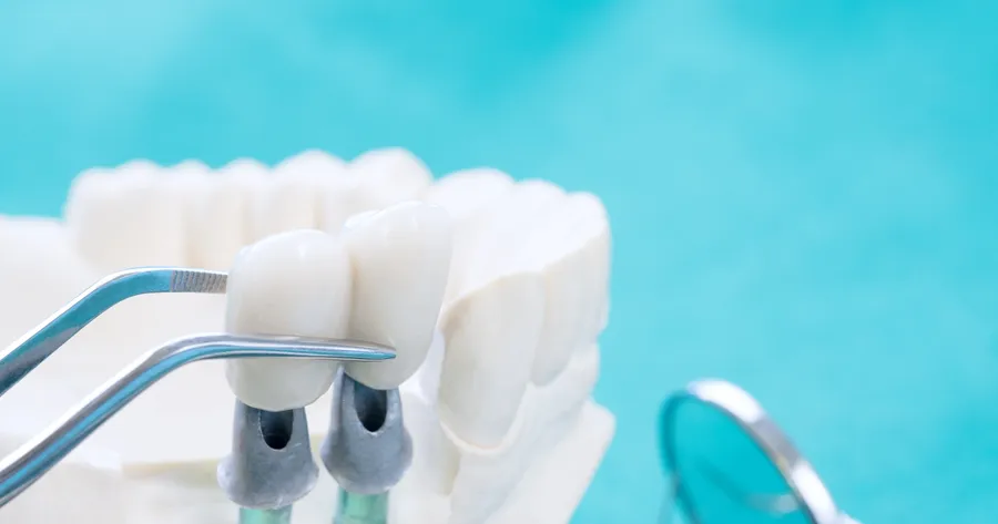Smile Bright: A Practical Guide to Finding Affordable Dental Implants in 2024
