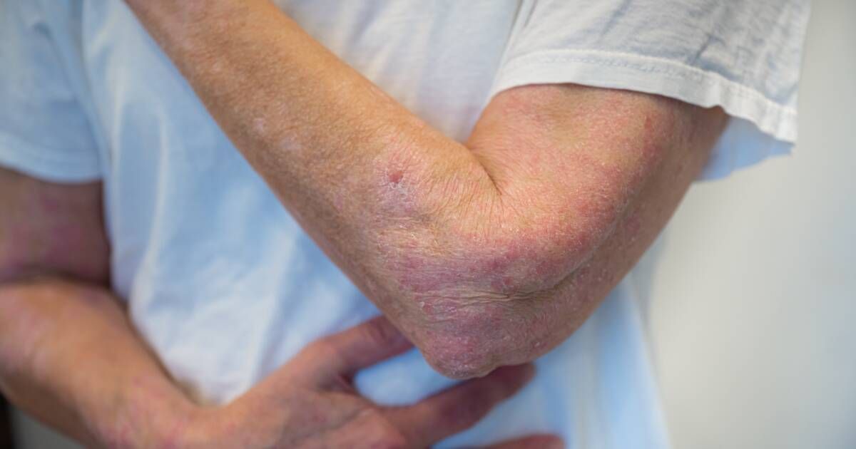 Plaque Psoriasis Warning Signs and What to Know Topic Tracer