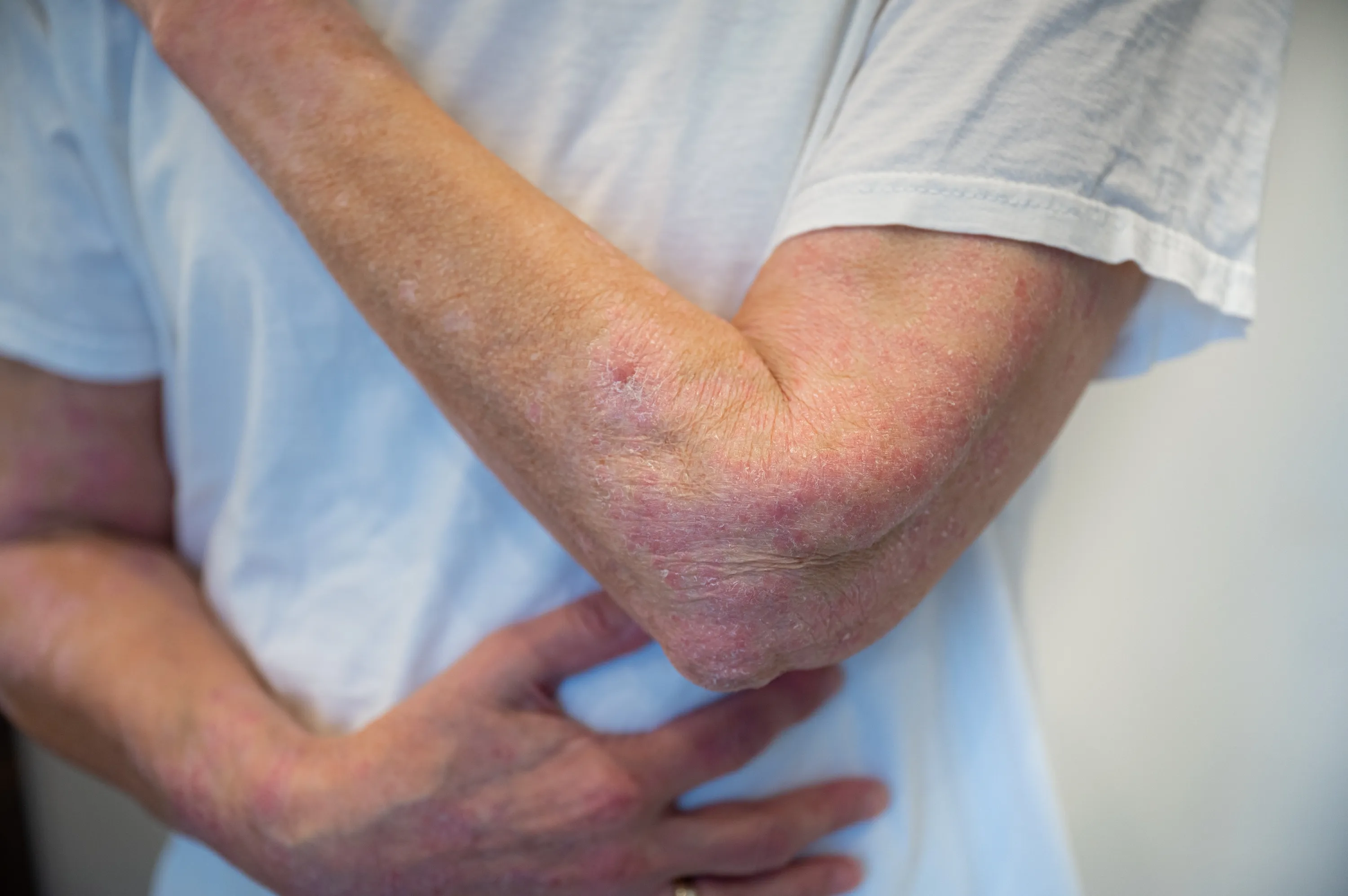 Plaque Psoriasis Warning Signs and What to Know Topic Tracer