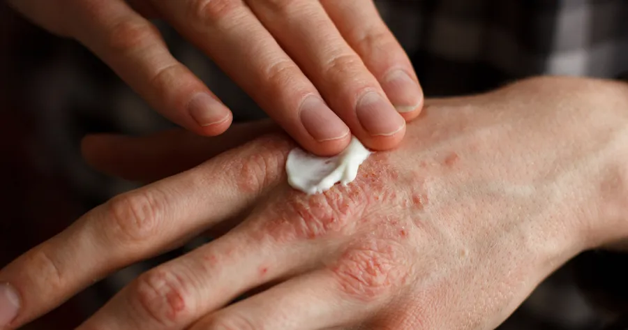 Psoriasis Treatment Solutions For Clearer Skin