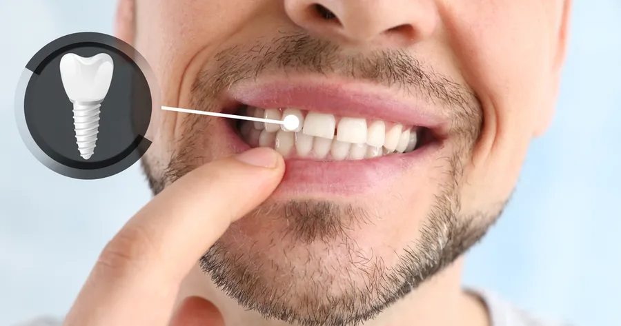 Same Day Tooth Replacement: Benefits and How to Find It