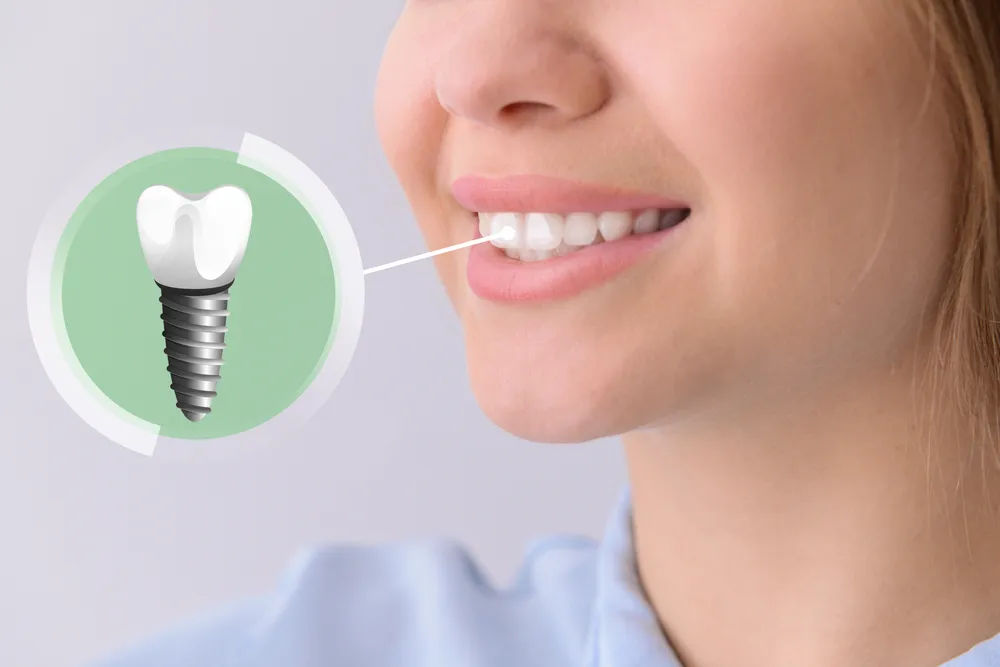 Why Pay More? Get the Best Dental Implants in Turkey for Less