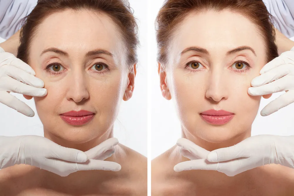 Say Goodbye to Wrinkles: How Face Fillers Can Transform Your Look Without Surgery