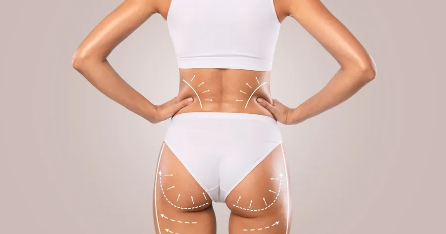 Everything To Know About Fat Removal