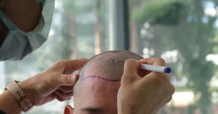 Why Turkey is a Popular Destination for Hair Transplants