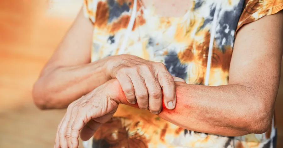 Signs and Symptoms of Psoriatic Arthritis and Why It’s Important to Detect Them