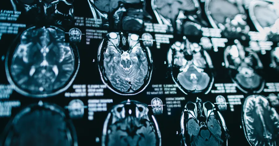 Understanding Multiple Sclerosis and Exploring the Latest Treatments