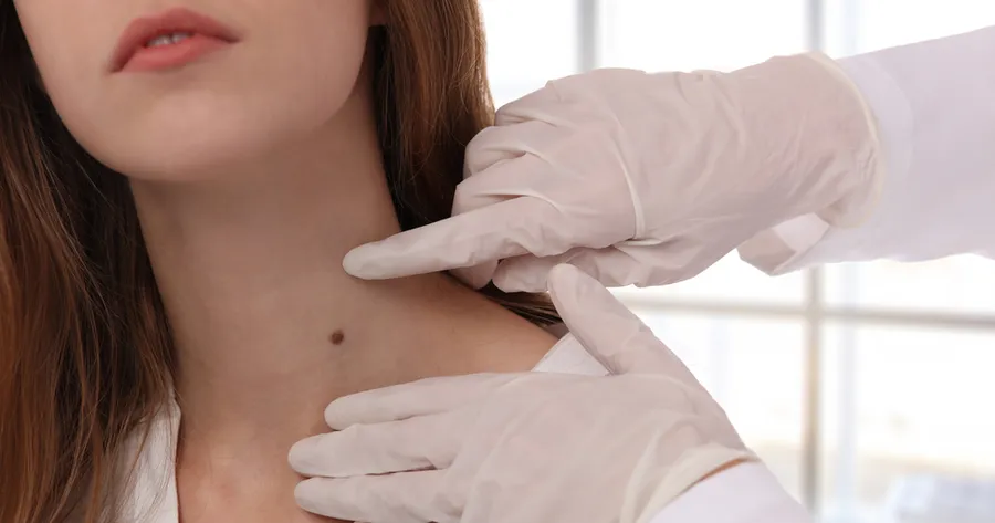 Mole Removal: Understanding the Process, Benefits, and Risks