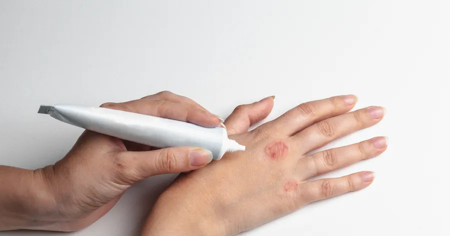 What Everyone Needs to Know About Atopic Dermatitis