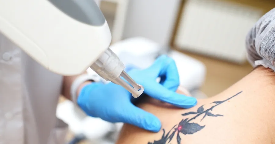 Tattoo Removal: What You Need To Know and How To Find the Right Clinic