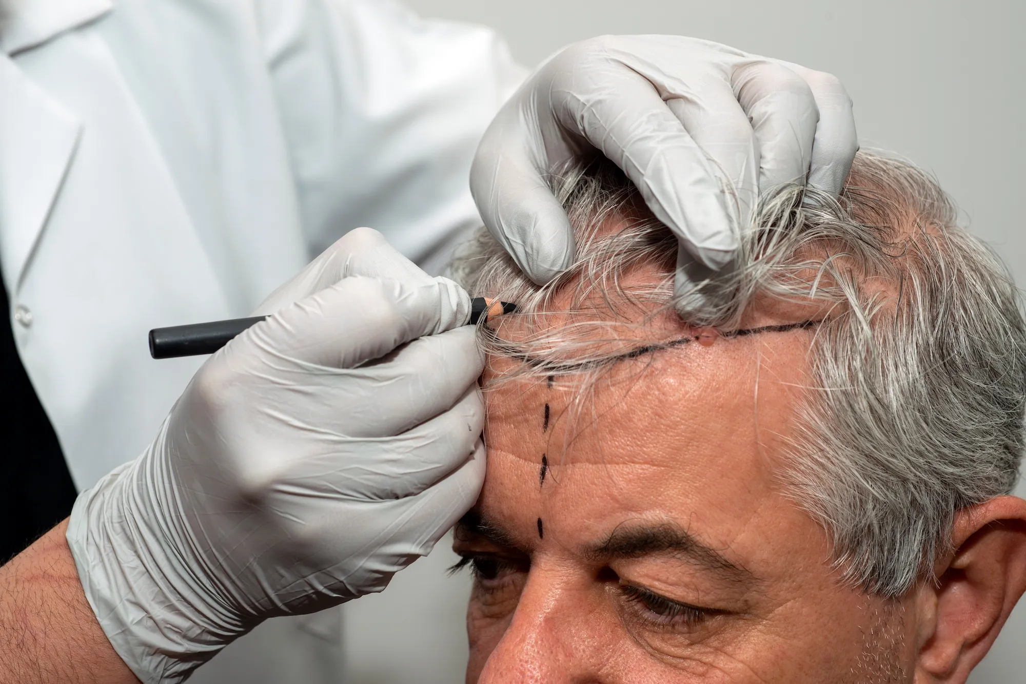 Exploring Restoration Options: The Different Types of Hair Transplants