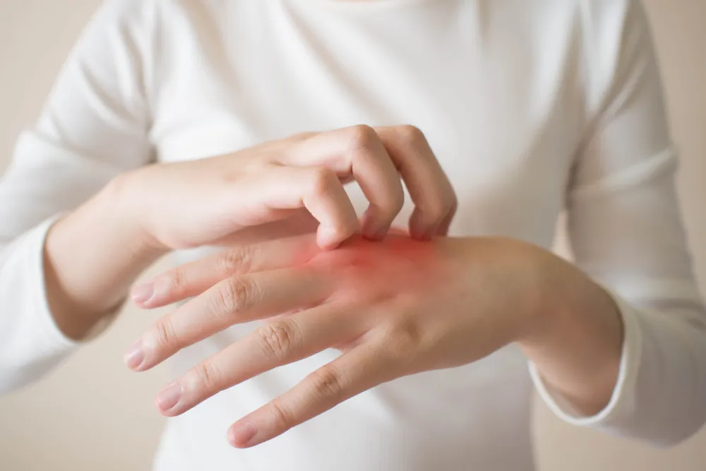 Symptoms, Signs and Available Treatments for Eczema