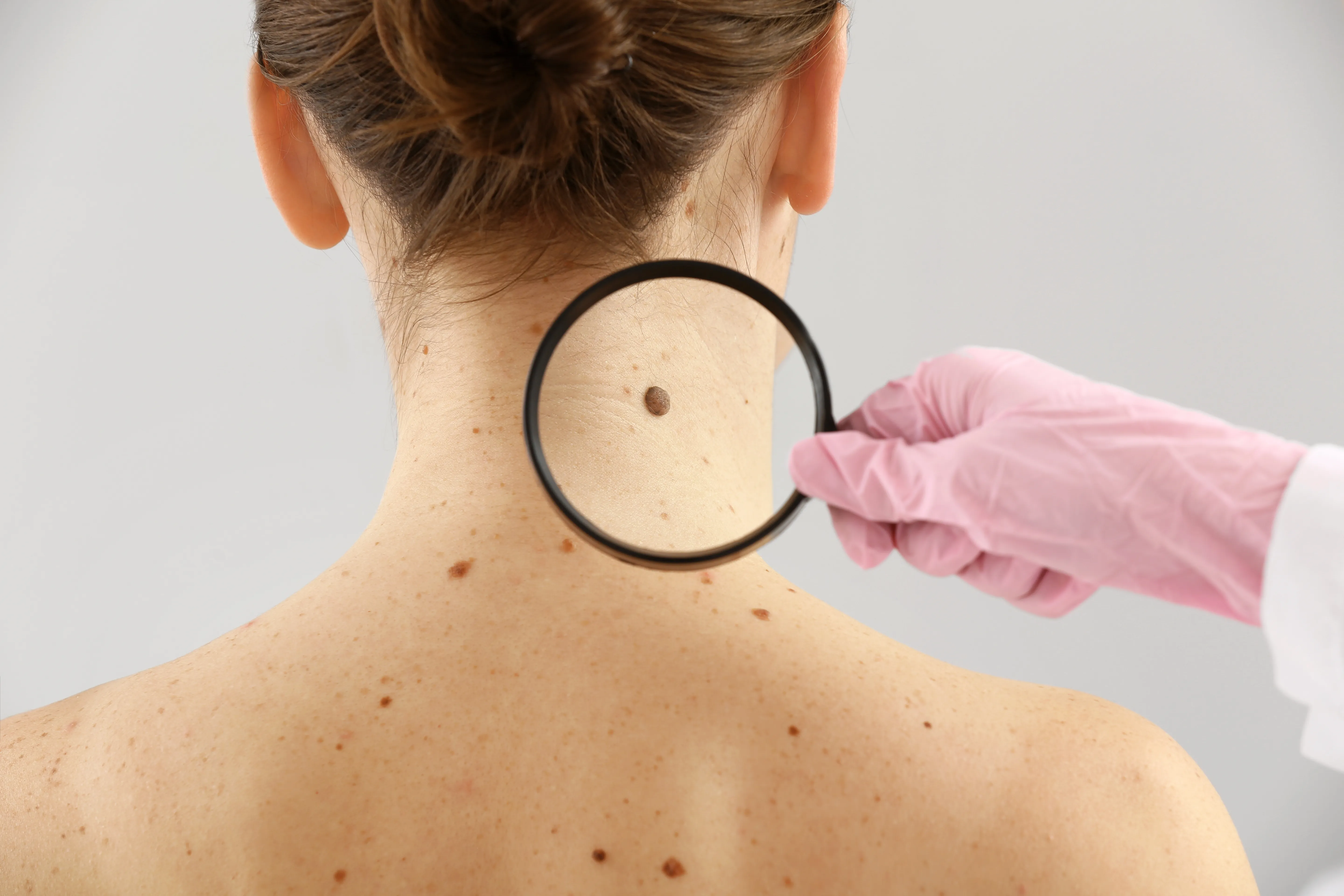 The Hidden Symptoms of Skin Cancer: 6 Signs You Shouldn’t Ignore