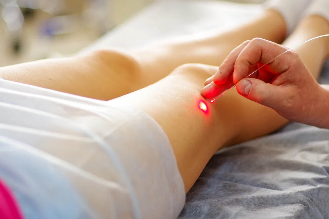 Maximize Your Skin Health with Spider Vein Laser Treatment