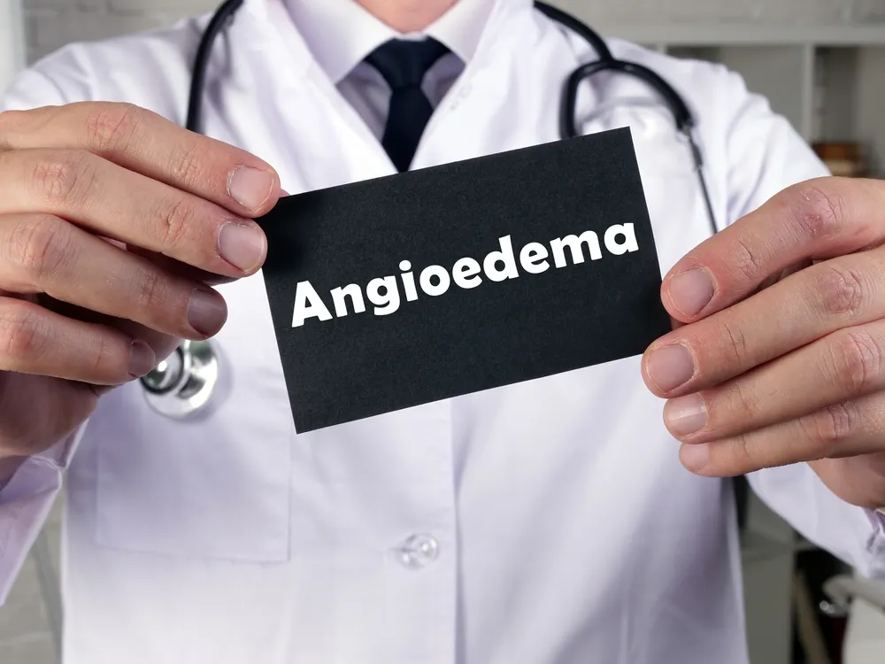 Get to Know the Early Signs of Angioedema That Shouldn’t Be Ignored