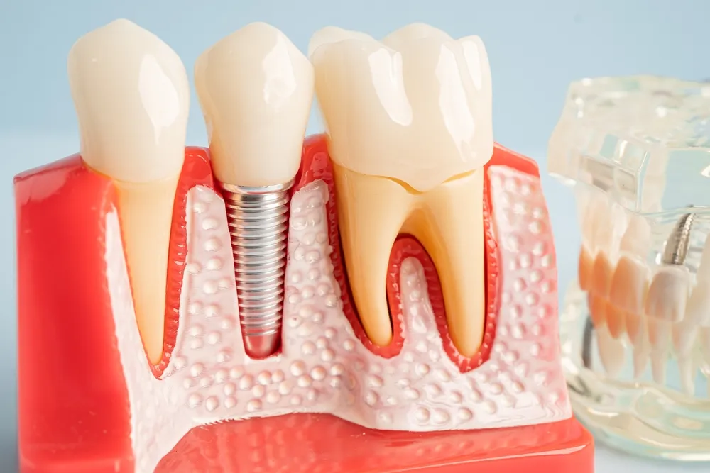 Need a New Tooth? Find A Dentist For Affordable Tooth Replacement Options