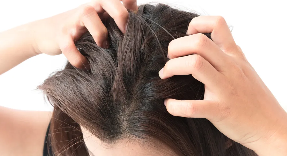 The Best Scalp Psoriasis Medicines: Effective Treatments for Relief