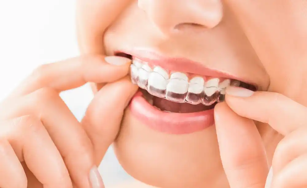 Affordable Invisible Dental Aligners: A Cost-Effective Solution