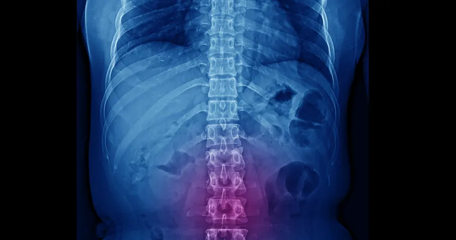 Understanding Spinal Stenosis: A Conditional Look at Symptoms, Causes, and Treatment Options