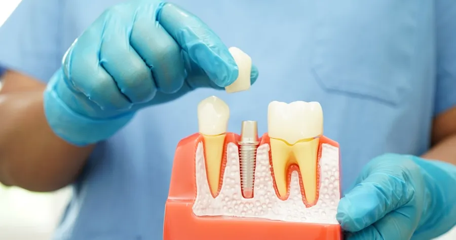 Considering Dental Implants? Here’s What You Need to Know