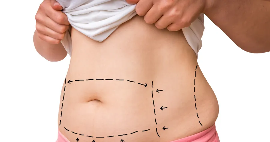 Tummy Tuck Clinical Trials: Benefits, Risks, and Eligibility Criteria Explained