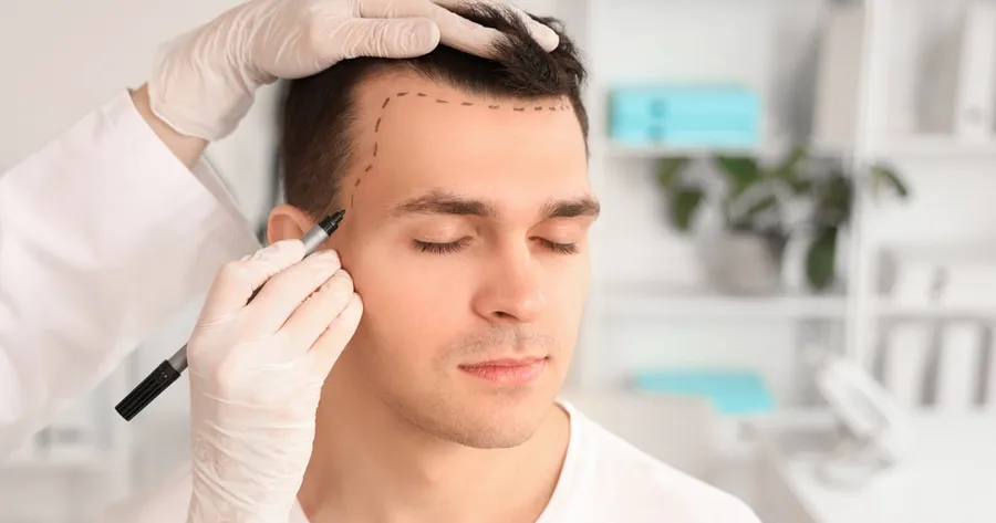 Thinking About a Hair Transplant? Here’s What You Should Know